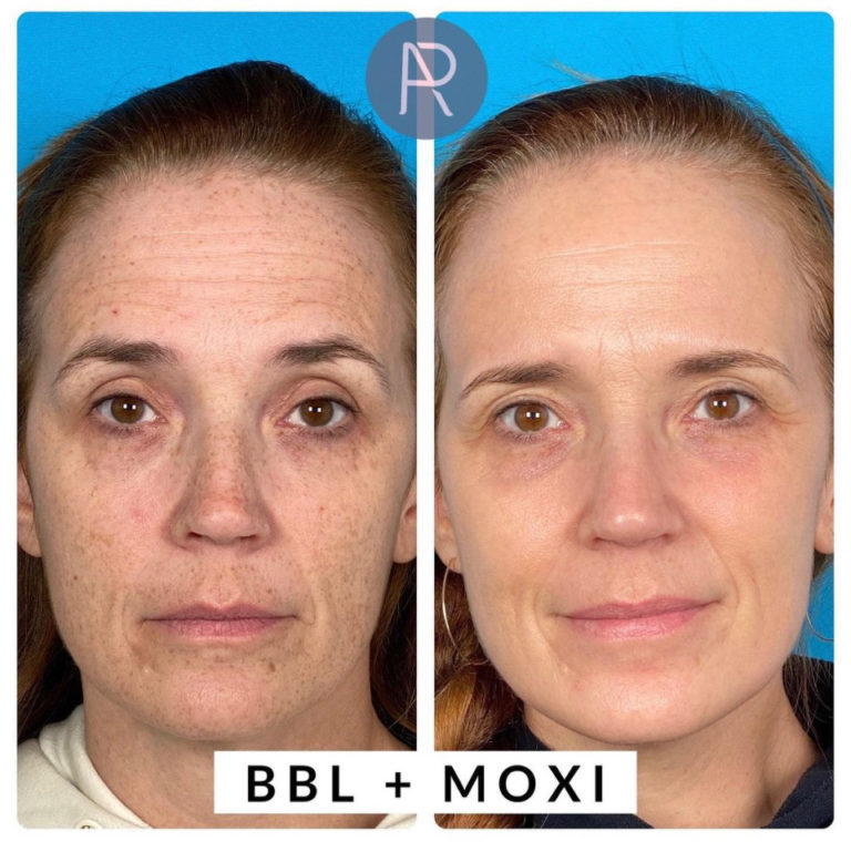 Moxi Laser - Austin & Reddick Dermatology